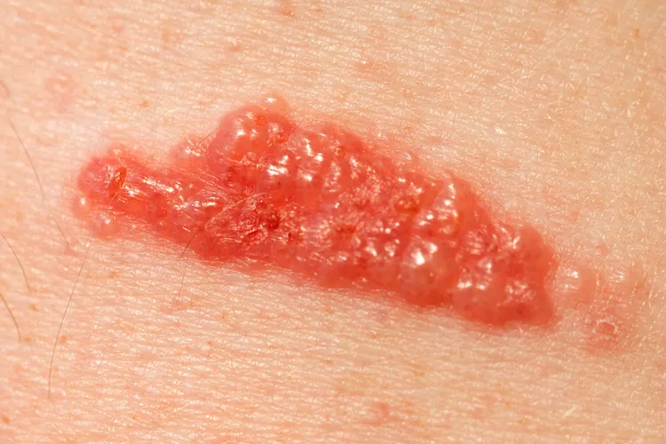 photo of Poison ivy rash on man's arm