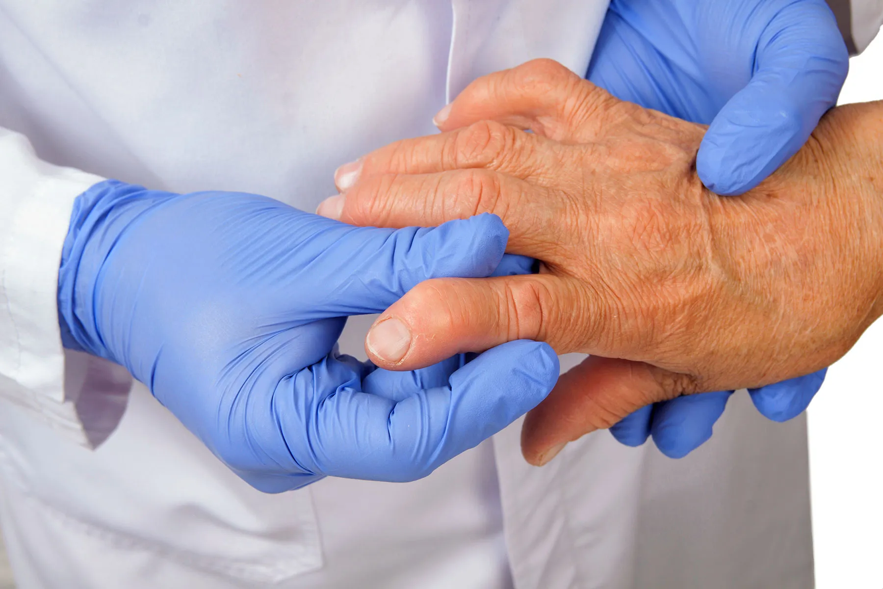 photo of senior patient with rheumatoid arthritis.