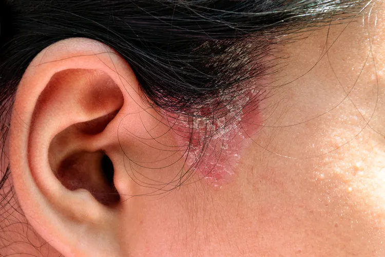 photo of facial ringworm fungal lesions.