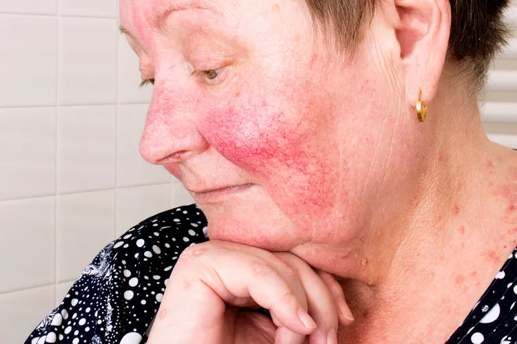 photo of rosacea on face