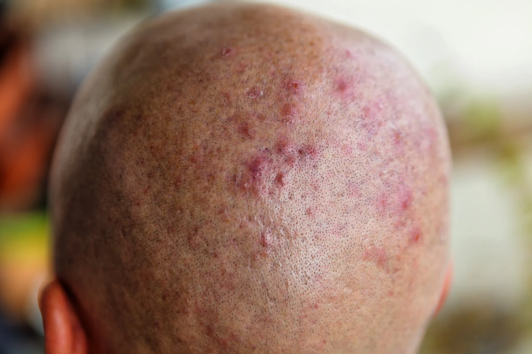 Pimples on Scalp WebMD: Unveiling the Mystery Behind Those Pesky Bumps