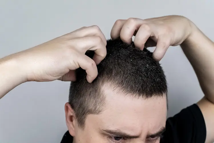 photo of Man suffering from Dandruff 