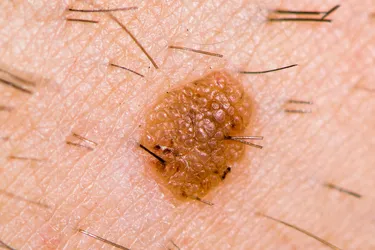 A seborrheic keratosis looks much like a mole. They're both caused by a cluster of skin cells. But seborrheic keratoses never become cancerous. (Photo credit: Ian Redding/Dreamstime)