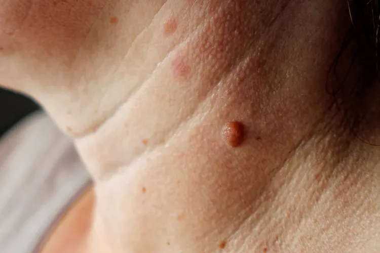 photo of  mole on a woman's neck