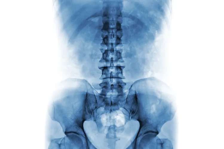 photo of x-ray of normal human lumbar spine