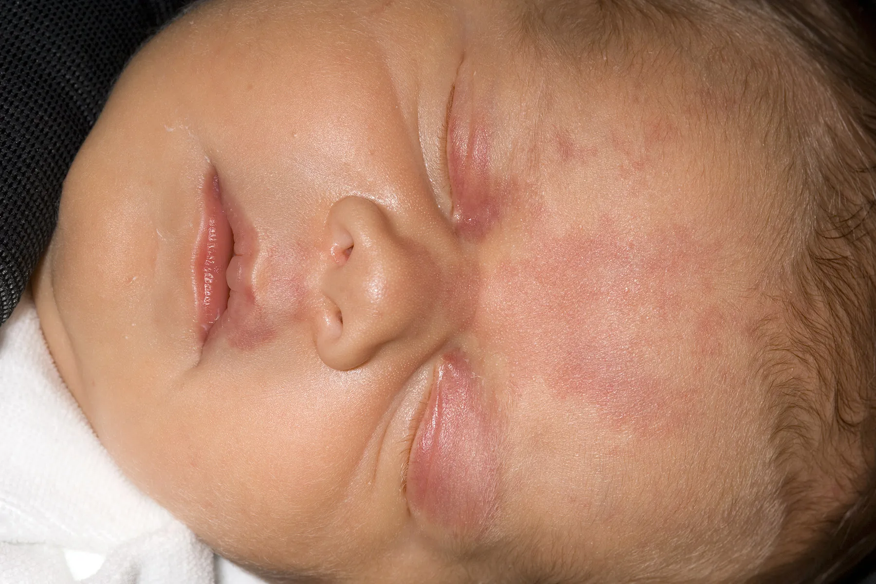 photo of Baby with stork bite birthmarks.