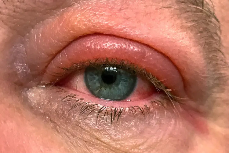 photo of eye and swollen eyelid