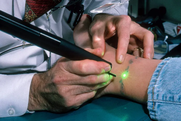 photo of a doctor removes a tattoo with a laser