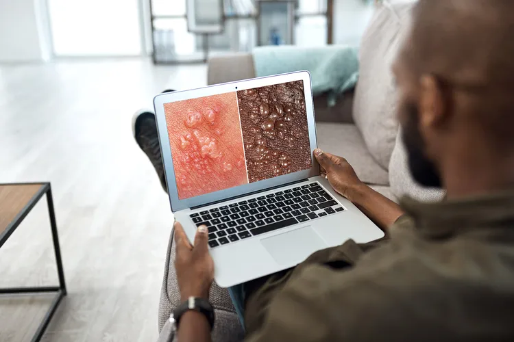 photo of man studying shingles rashes online