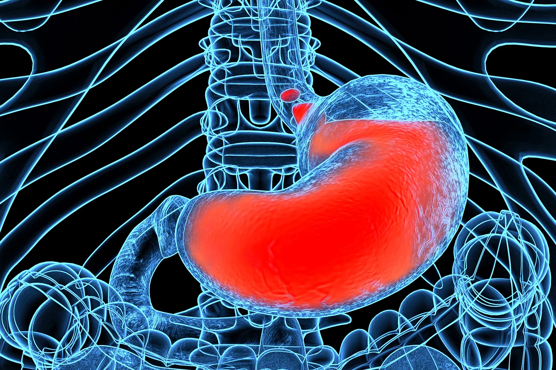 photo of Acid reflux, heartburn