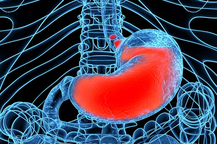 photo of Acid reflux, heartburn