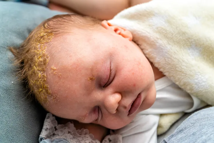 photo of newborn with cradle cap