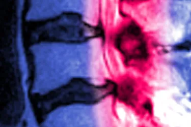 Foraminal stenosis happens along your spine. Photo Credit: Medical Body Scans / Science Source