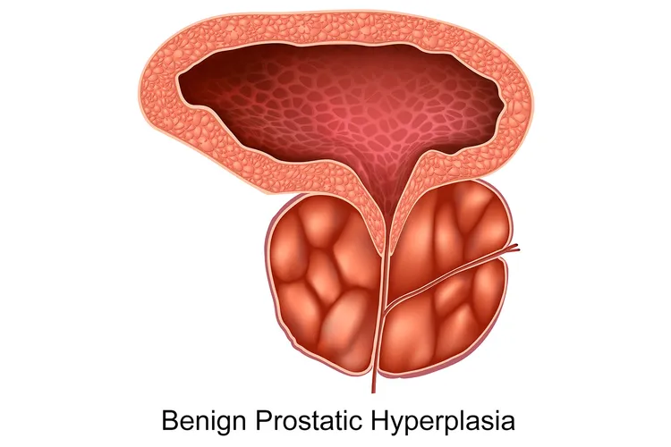 photo of Benign Prostatic Hyperplasia