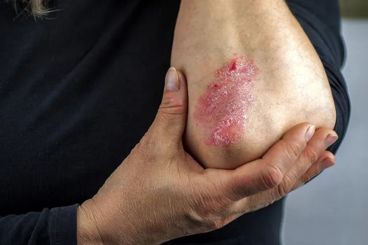 photo of Psoriasis on elbow