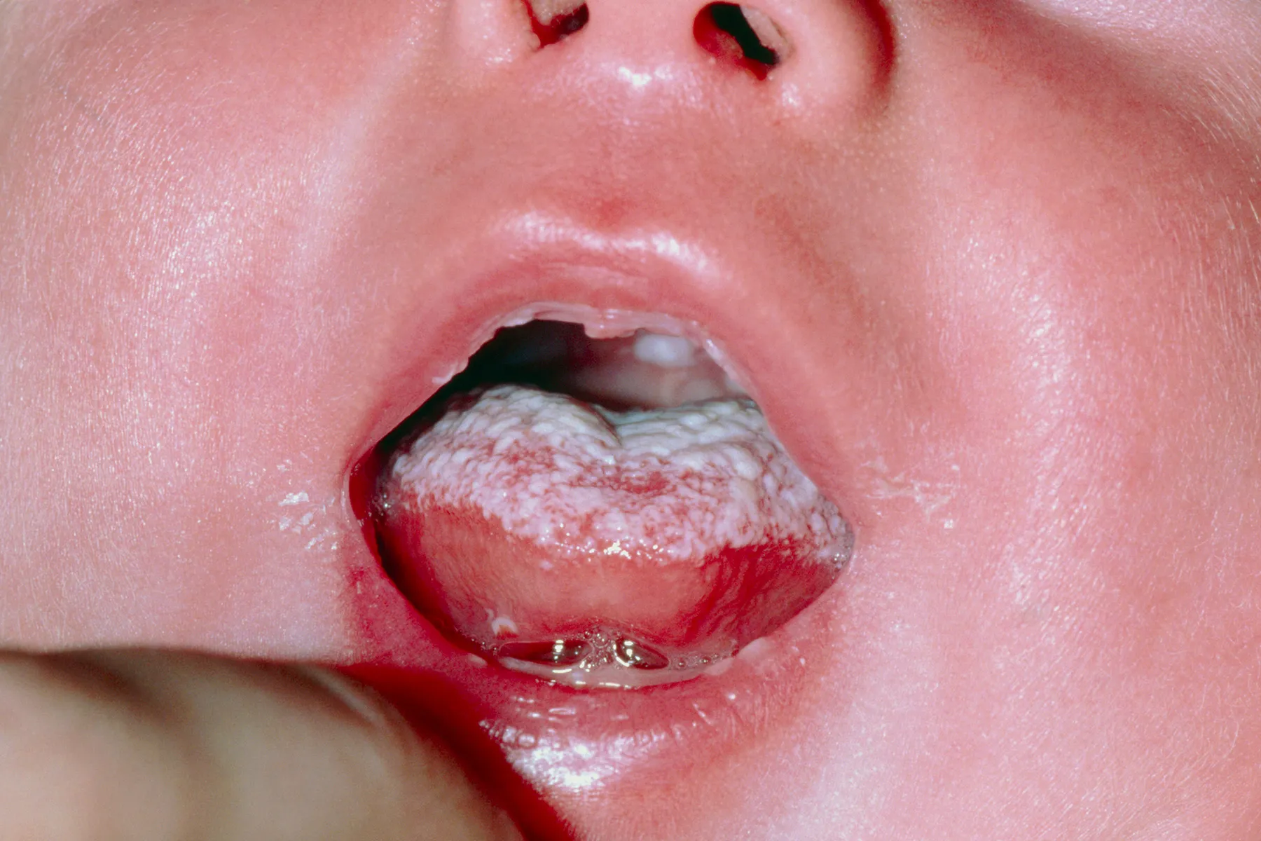 photo of Oral candidiasis (thrush)