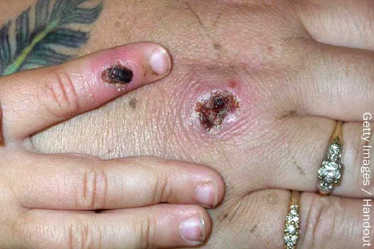 monkeypox on hand