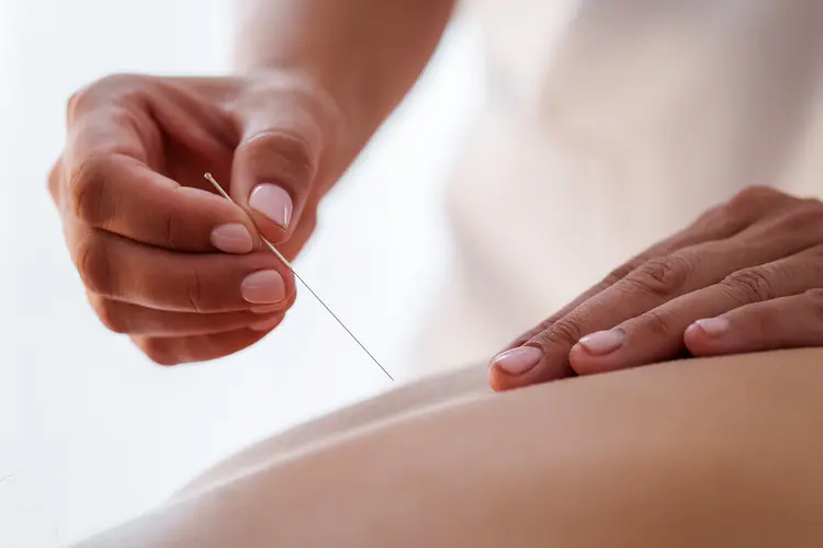 photo of acupuncture on back