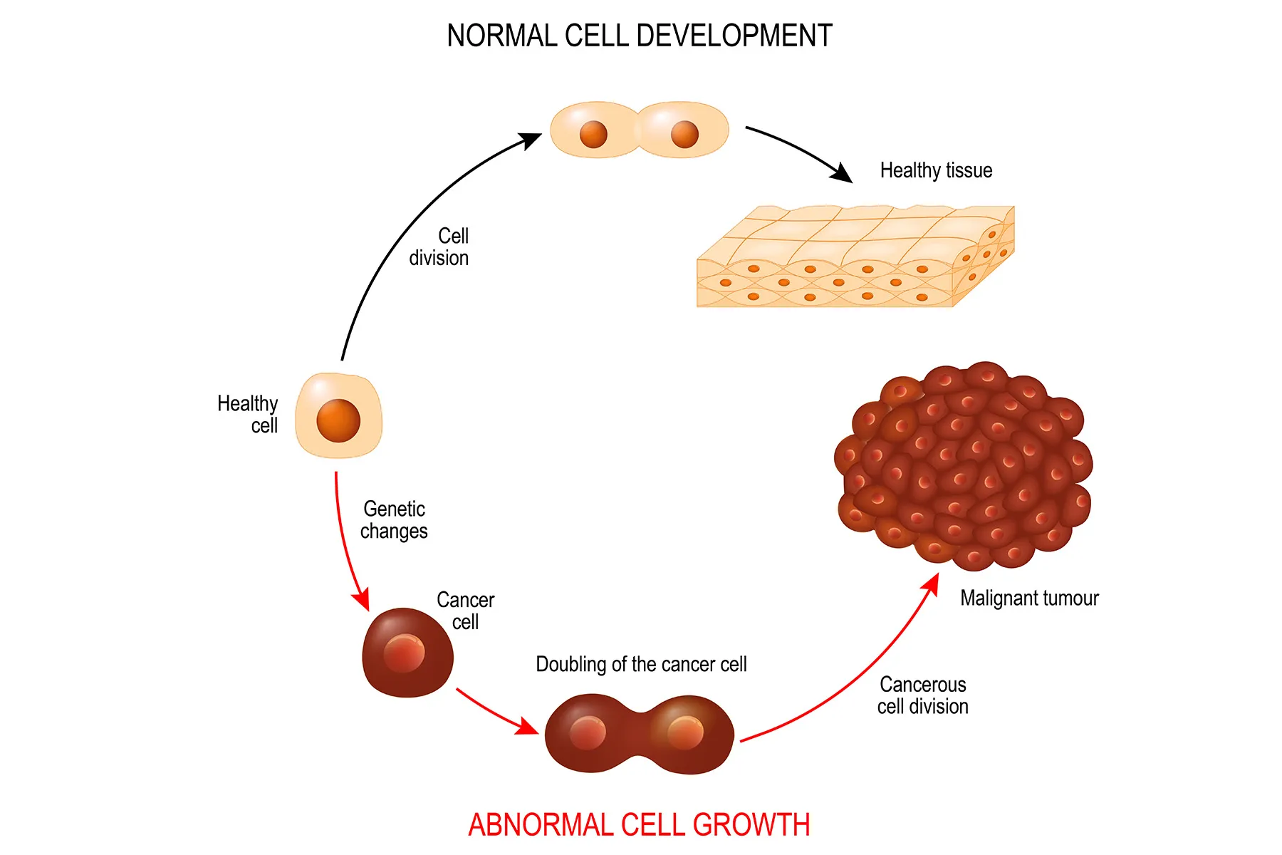 The Stages of Cancer According to the TNM System