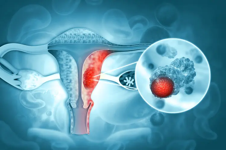 photo of uterine cancer
