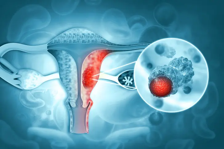 Uterine Cancer Treatment Options Uterine Cancer Treatment Options