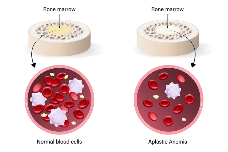Cause: Aplastic Anemia