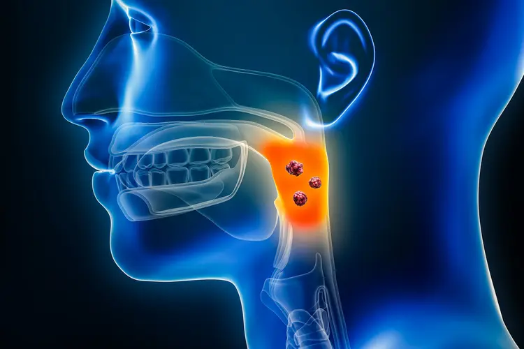 photo of oropharyngeal cancer