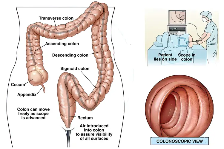 illustration of colonoscopy