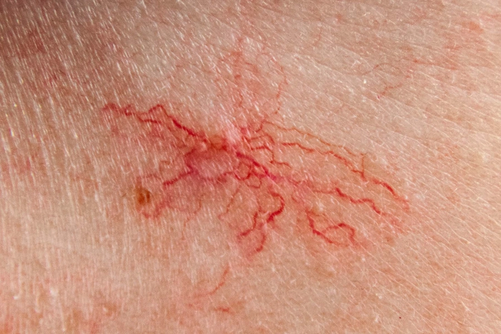 How to Treat Spider Angiomas With MASH How to Treat Spider Angiomas With MASH