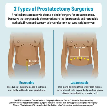 Prostatectomy  infographic