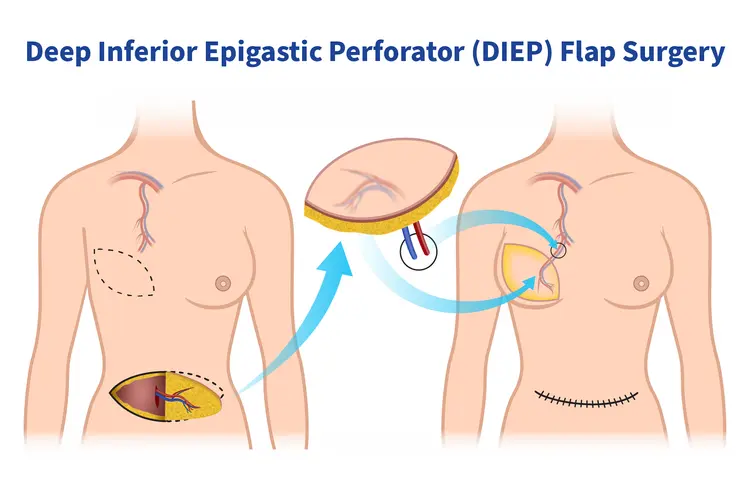 photo of DIEP Flap surgery