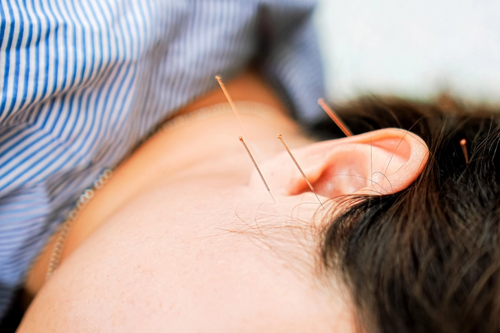 Acupuncture to Quit Smoking? Acupuncture to Quit Smoking?