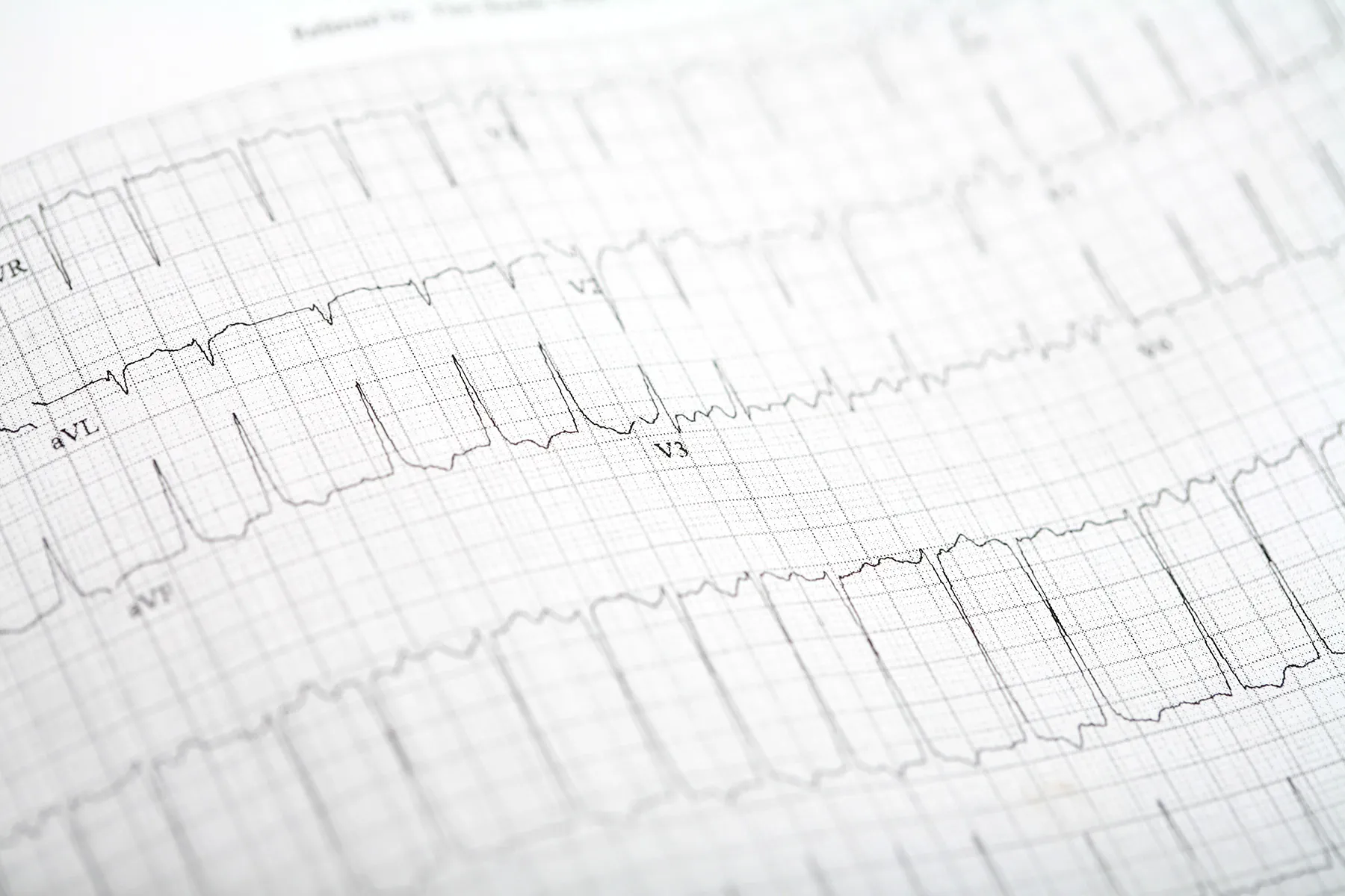 photo of afib ekg