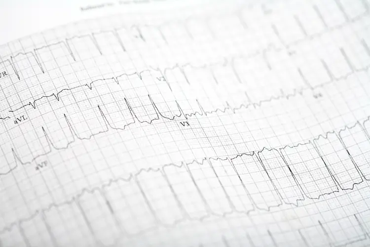 photo of afib ekg