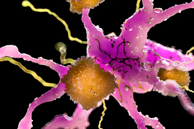 photo of amyloid plaques