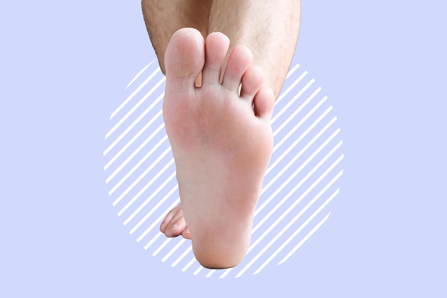 What to Know About High Arches