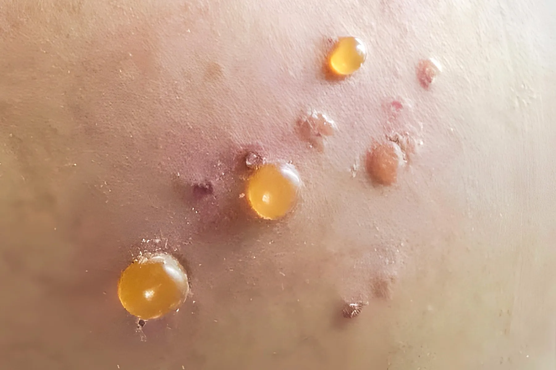 photo of bullous pemphigoid blisters