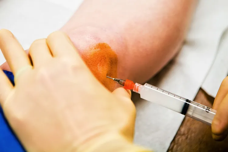 photo of cortisone injection behind knee