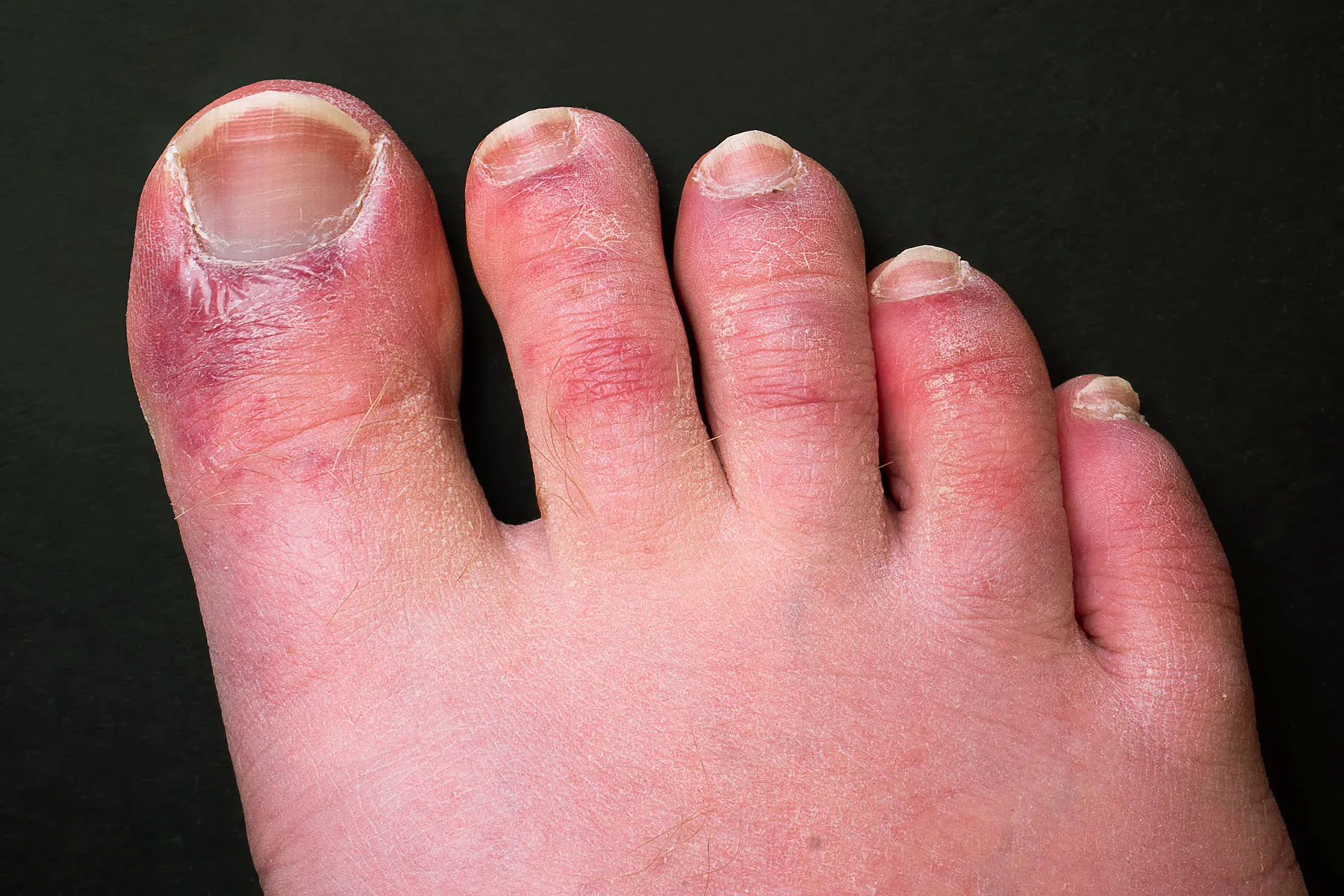 photo of covid toes