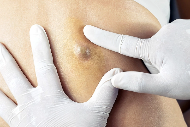 Cyst Cyst