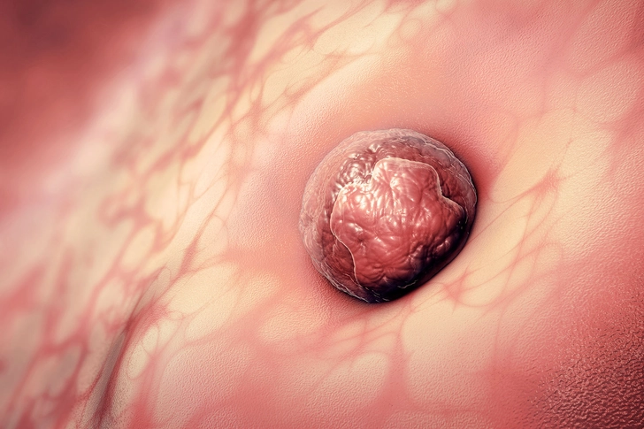 Implantation