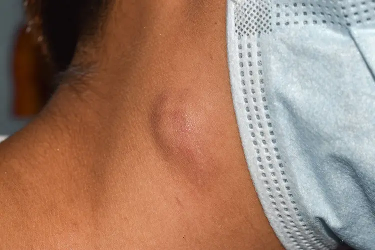 photo of enlarged lymph node