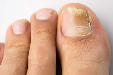 A fungal nail infection occurs when a fungus attacks a fingernail, a toenail, or the skin under the nail, called the nail bed. Photo credit: iStock/Getty Images