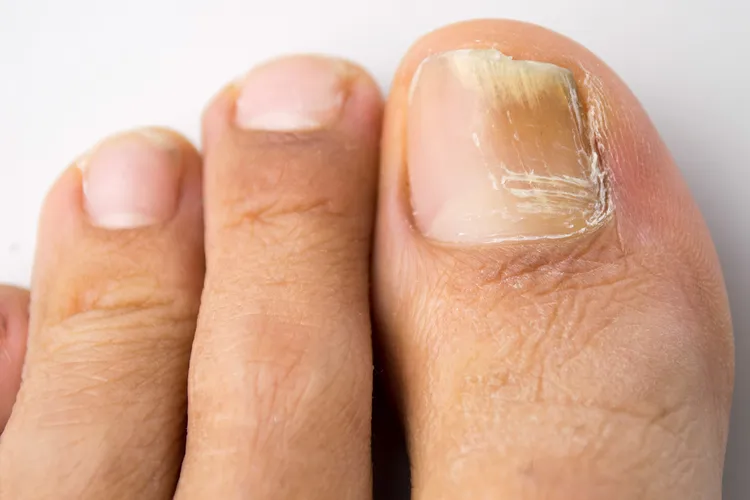 photo of fungal toenail infection
