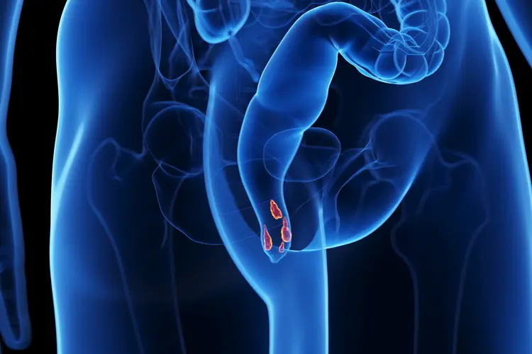 illustration of hemorrhoids