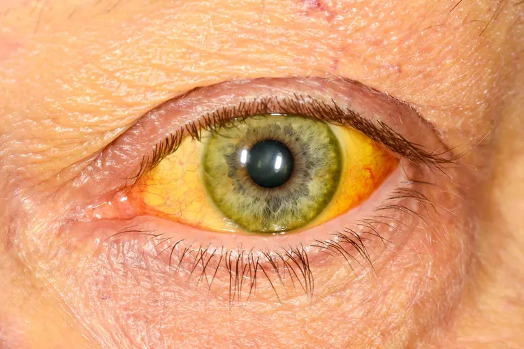 photo of jaundice