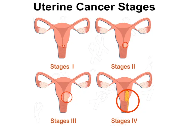 photo of uterine cancer stages