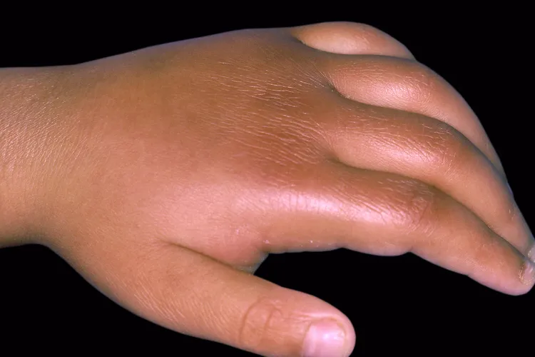 photo of Kawasaki Disease on child's hand