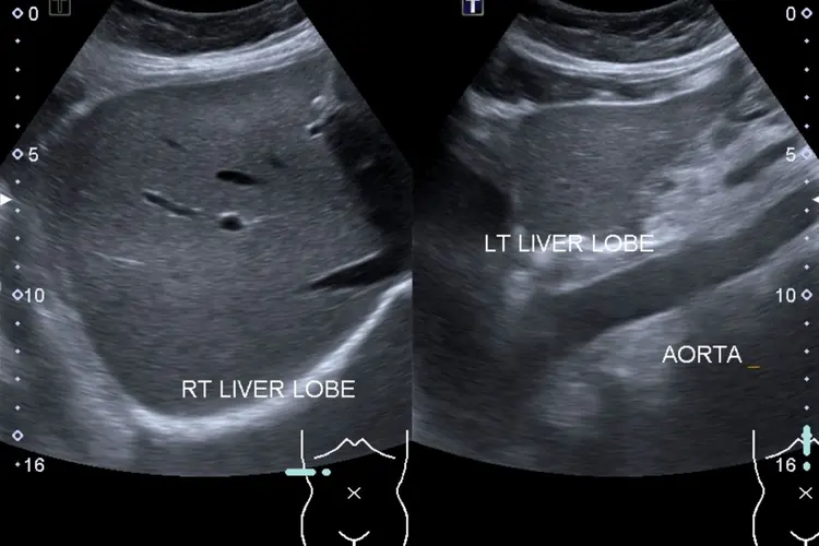photo of liver ultrasound