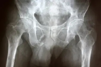 photo of metastatic bone  cancer in pelvis